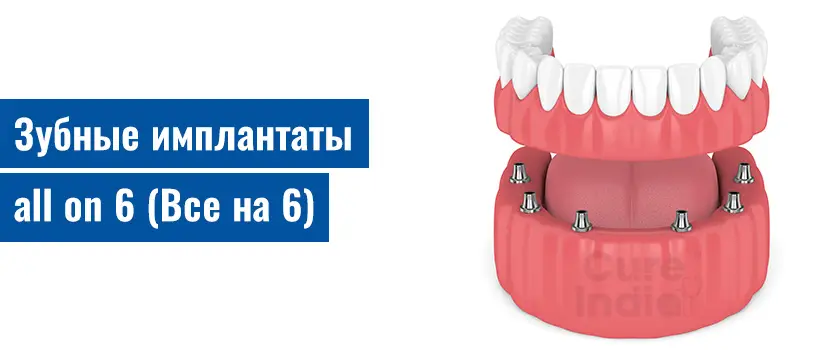 Зубные имплантаты all on 6 (Все на 6)