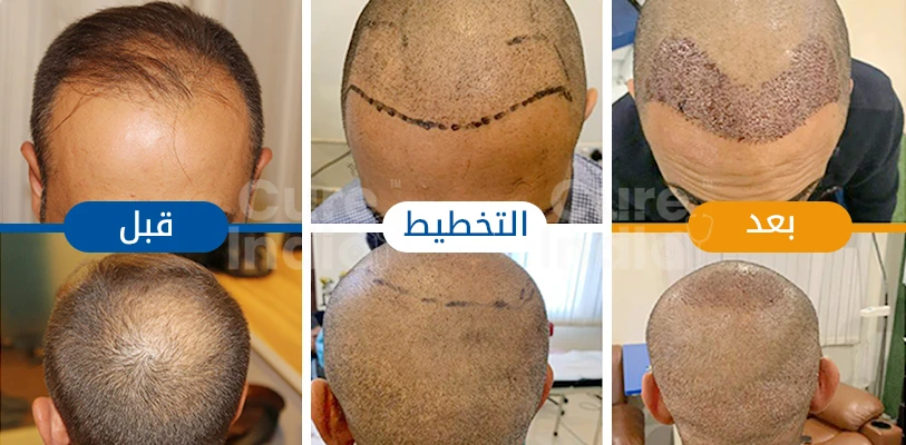 صور قبل وبعد زراعة الشعر