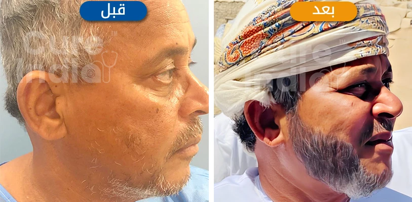 صورة قبل وبعد عملية زراعة الشعر