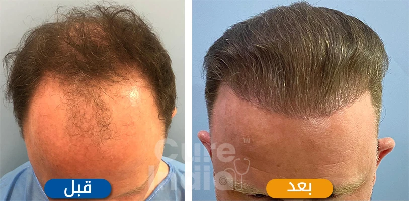 خطط لجراحة زراعة الشعر في الهند بتكاليف معقولة