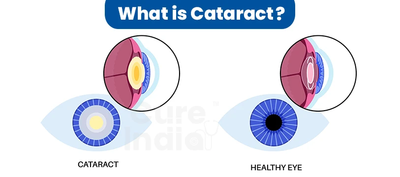 What are Cataracts?