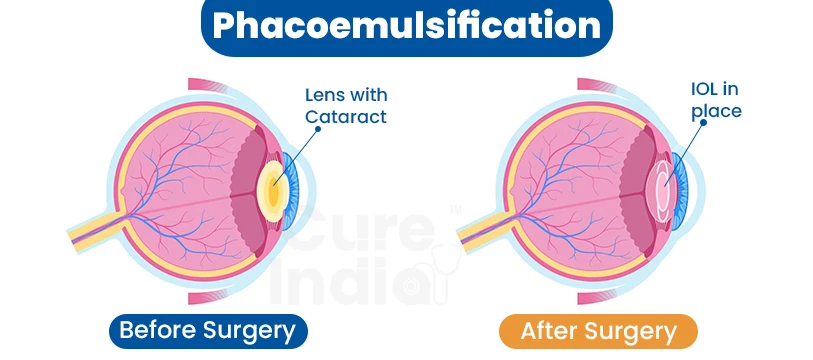 Phacoemulsificat on Surgery in India