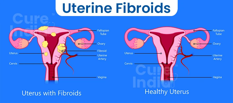 Uterine Fibroid Treatments in India