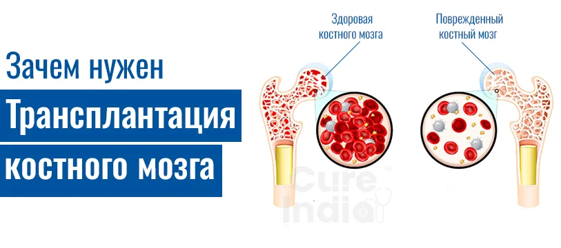 Зачем Нужна Трансплантация Костного Мозга  Клеток