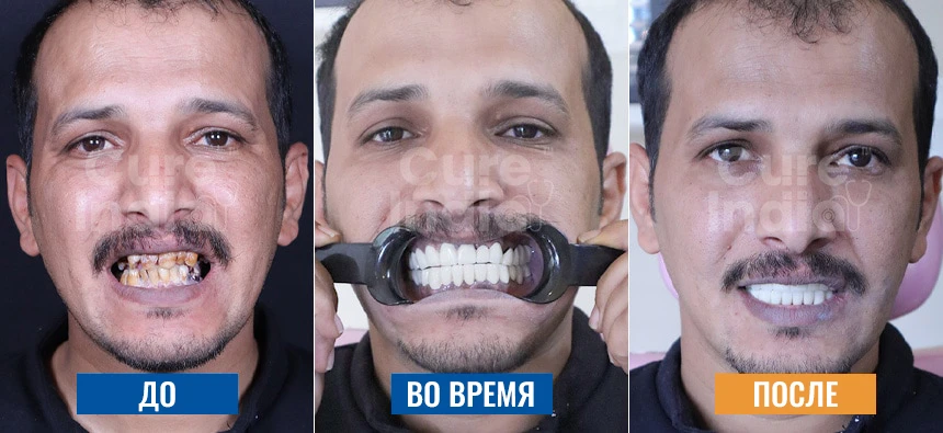 Фотографии Голливудской Улыбки До И После