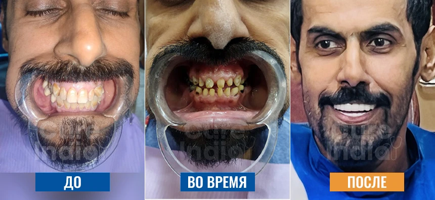 Фотографии Голливудской Улыбки До И После