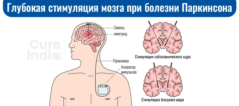 Операция Глубокая Стимуляция Мозга В Индии