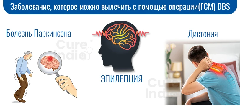 Заболевания, Которые Можно Лечить С Помощью Операция Глубокой Стимуляция Мозга