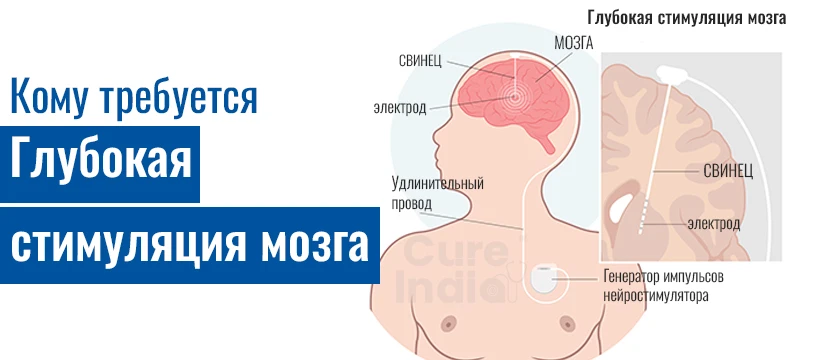 Устройства Для Глубокой Стимуляции Мозга Для Лечения Болезни Паркинсона