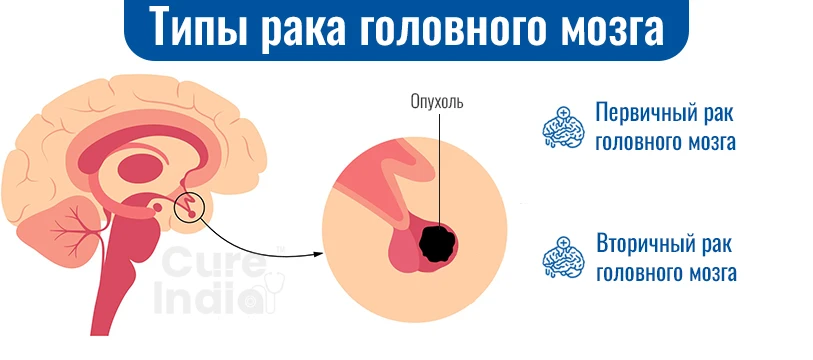 Каковы Типы Рака Мозга