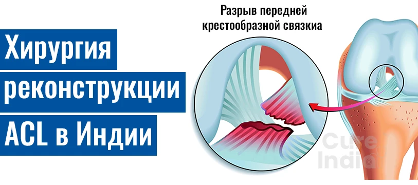 Операция Восстановления Передней Крестообразной Связки В Индии