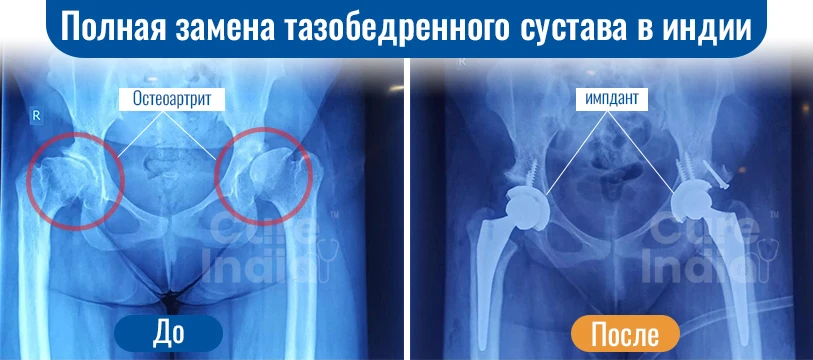 Операцию По Замене Тазобедренного Сустава В Индии