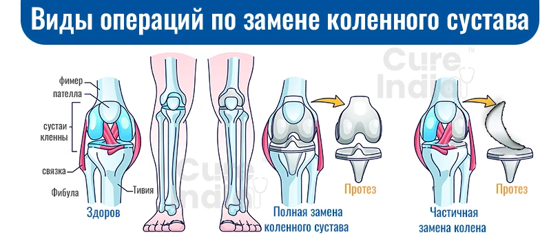 Виды Операций По Замене Коленного Сустава
