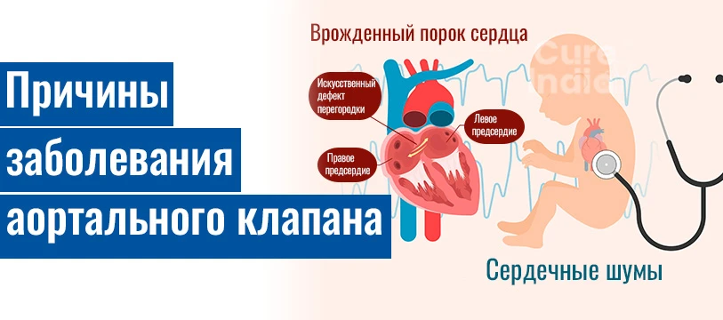 Каковы Общие Причины Аортального Стеноза