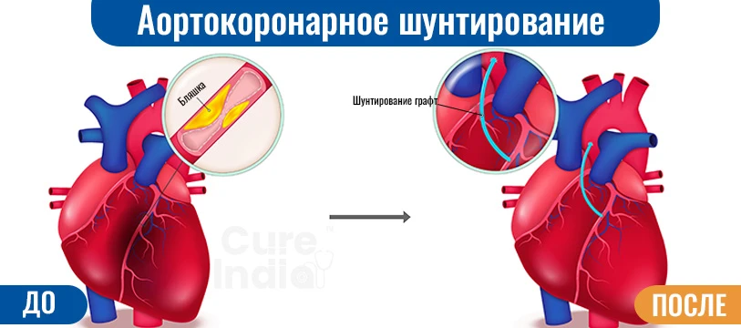 Что Такое Операция Шунтирования Коронарных Артерий