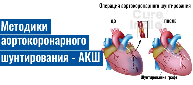 Техника Проведения Операции Шунтирования Коронарных Артерий