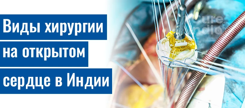 Виды Операция На Открытом Сердце
