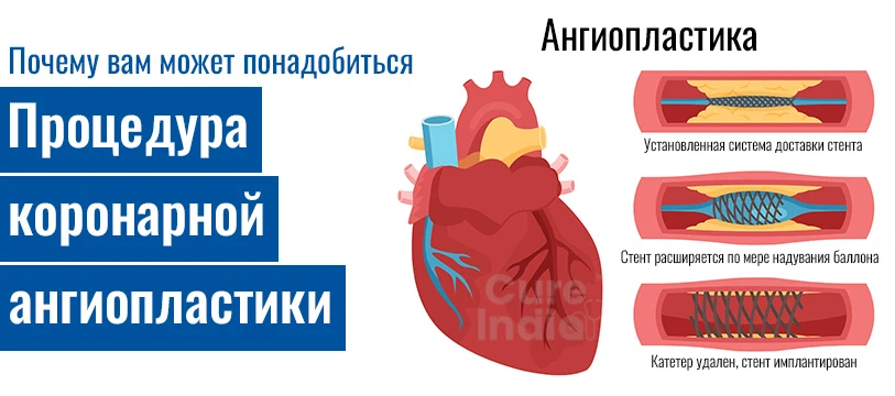Процедура Коронарная Ангиопластика Хирургия В Индии