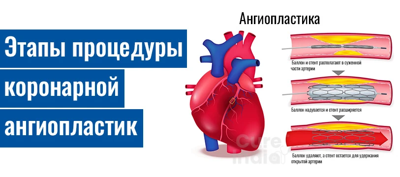 Этапы Процедуры Коронарная Ангиопластика Хирургия