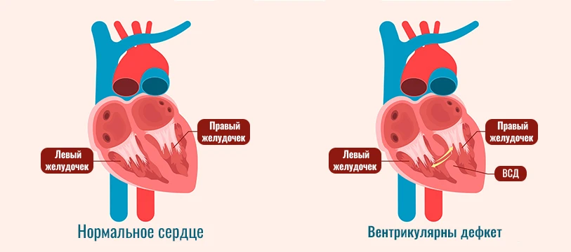 Дефект Межжелудочковой Перегородки Лечение