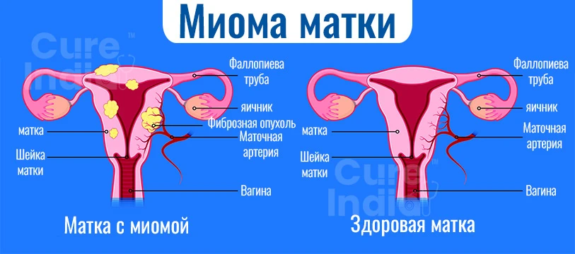 Что Такое Миома Матки