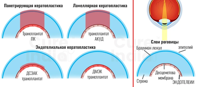Сквозная кератопластика - Виды Операций По Пересадке