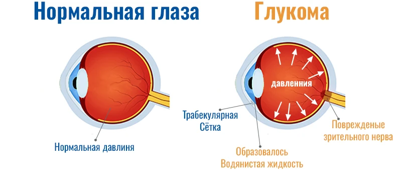 Глаукома Операция В Индии