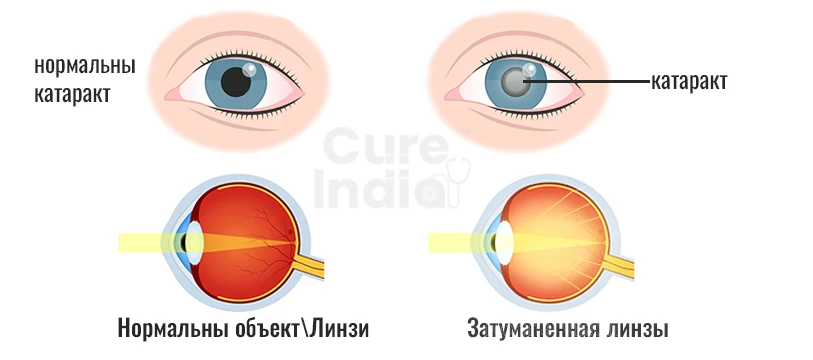 Операция Катаракта Как Проходит