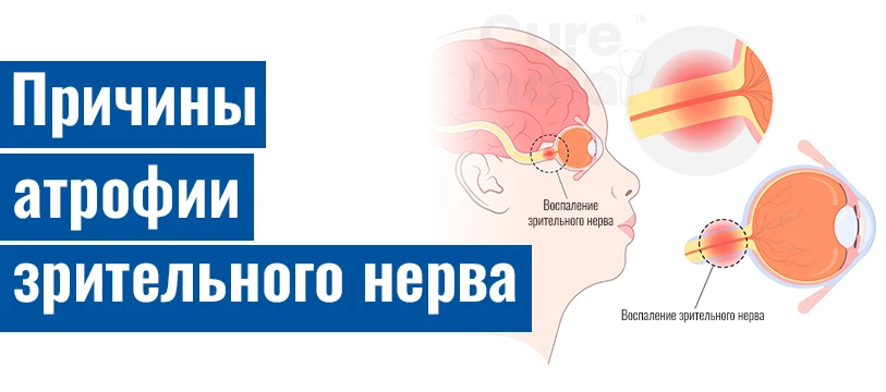 Причины Атрофии Зрительного Нерва