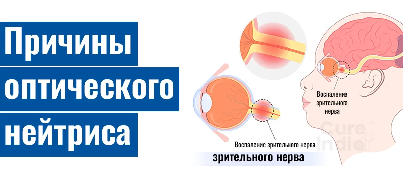 Причины Возникновения Неврита Зрительного Нерва