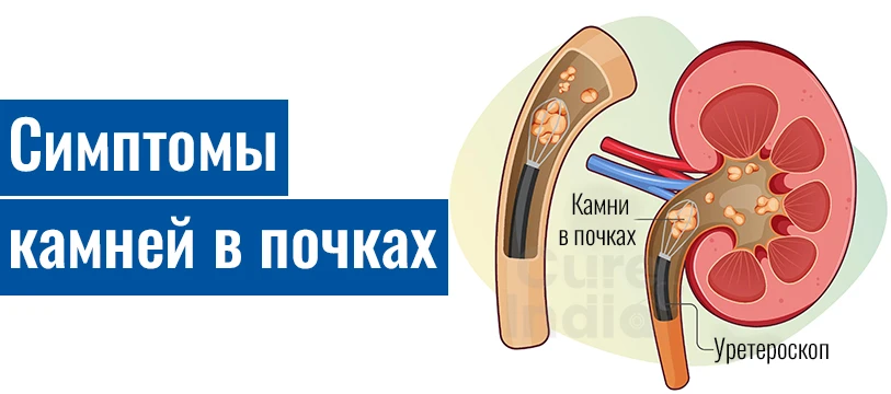 Камни В Почках Симптомы