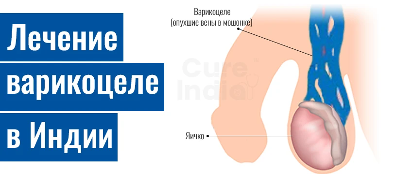 Проходит Операция По Удалению Варикоцеле В Индии