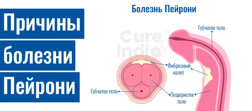 Вызывает Болезнь Пейрони
