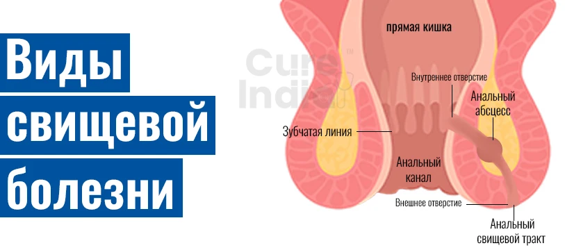 Типы Свищей И Каковы Их Симптомы
