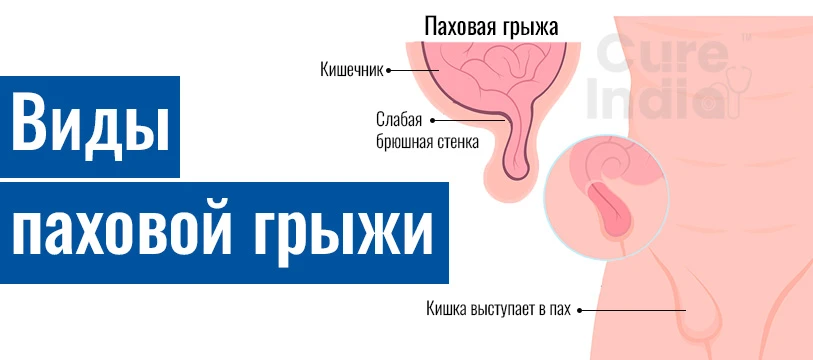 Виды Паховых Грыж