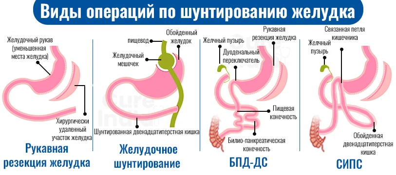 Виды Шунтирования Желудка