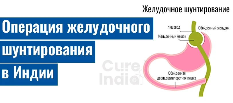 Процедура Рукавного Шунтирование Желудка В Индии