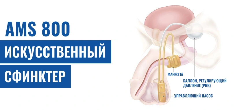 AMS 800 Искусственный Сфинктер - Как Это Работает