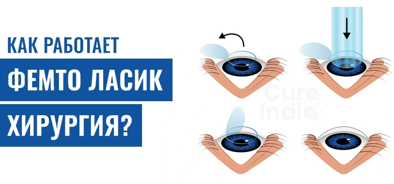 Как Работает Коррекция Зрения Фемто Ласик Хирургия