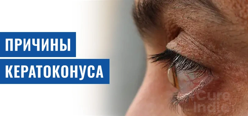 Причины Кератоконуса