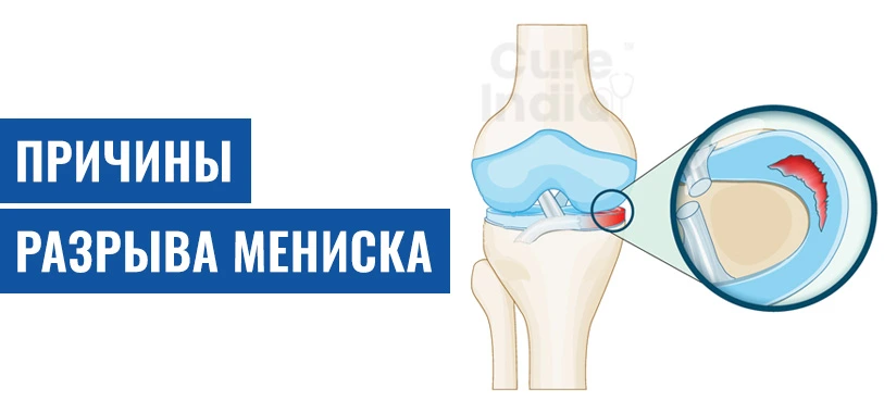 Причины Разрыва Мениска