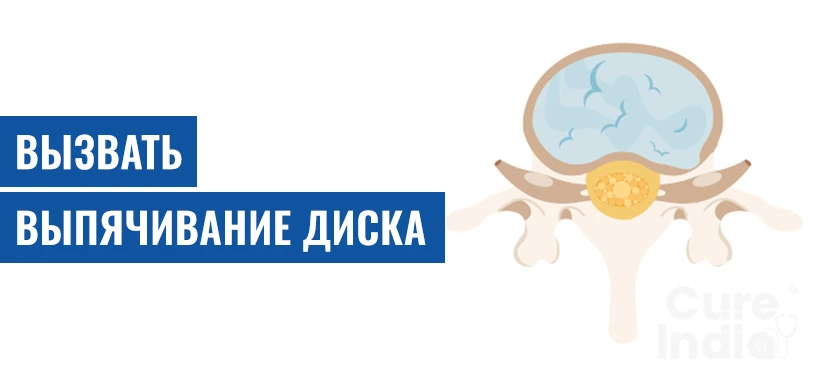 Вызвать Выпячивание Диска В Нижней Части Спины