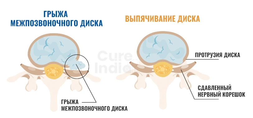 Разница Между Выбуханием И Грыжей Диска