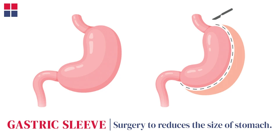What is a Gastric Sleeve Surgery
