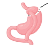 gastric-bypass-package-istanbul-turkey