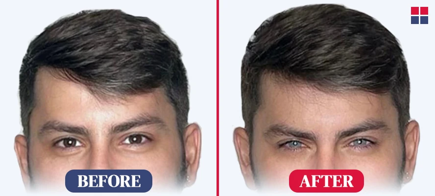 Kerato Laser Eye Color Change Surgery Before After