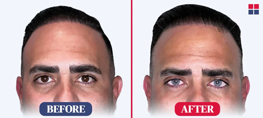 Kerato Laser Eye Color Before After Photo