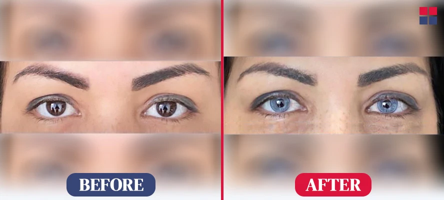 Eye Color Before After Photo Kerato Laser