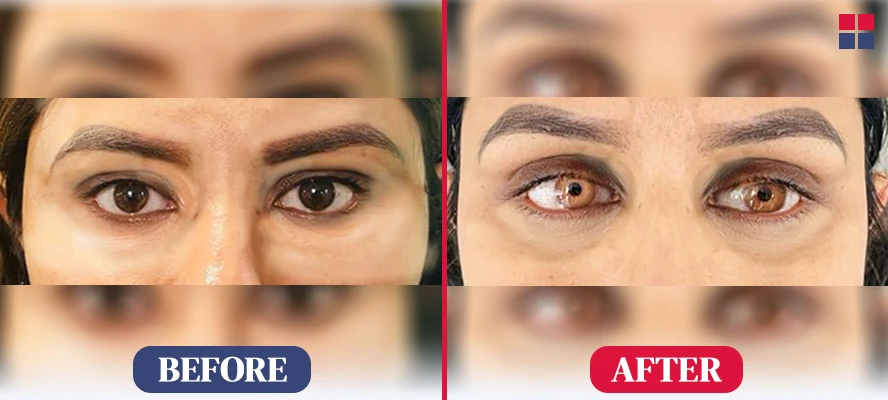 Eye Color Change Before After Pictures
