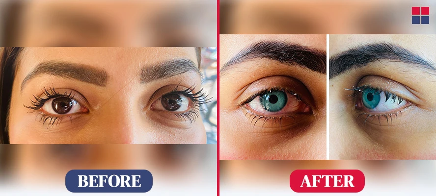 Kerato Laser Eye Color Change Before After